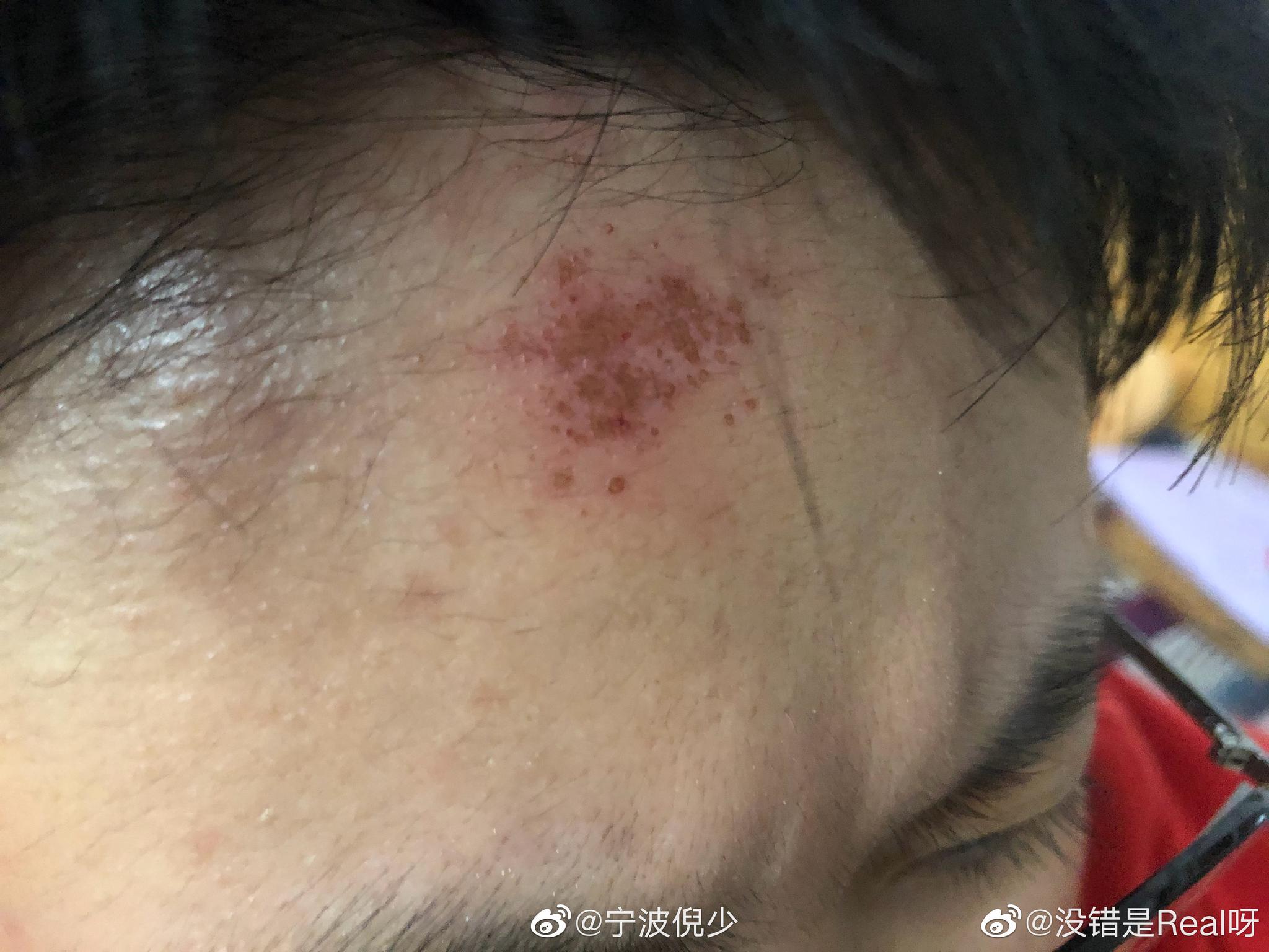 在春晓镇上"倾城国际"理发店,烫头发时操作失误,导致烫发药水灼伤前额