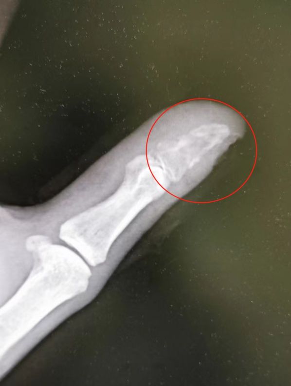 男子拇指被小狗咬伤，一个月后指骨被“吃空”休闲区蓝鸢梦想 - Www.slyday.coM