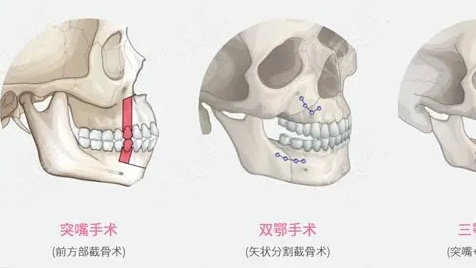 美美说说做完双颚正颌手术有后悔吗?后遗症有哪些?|手术|面部|轮廓_新浪新闻