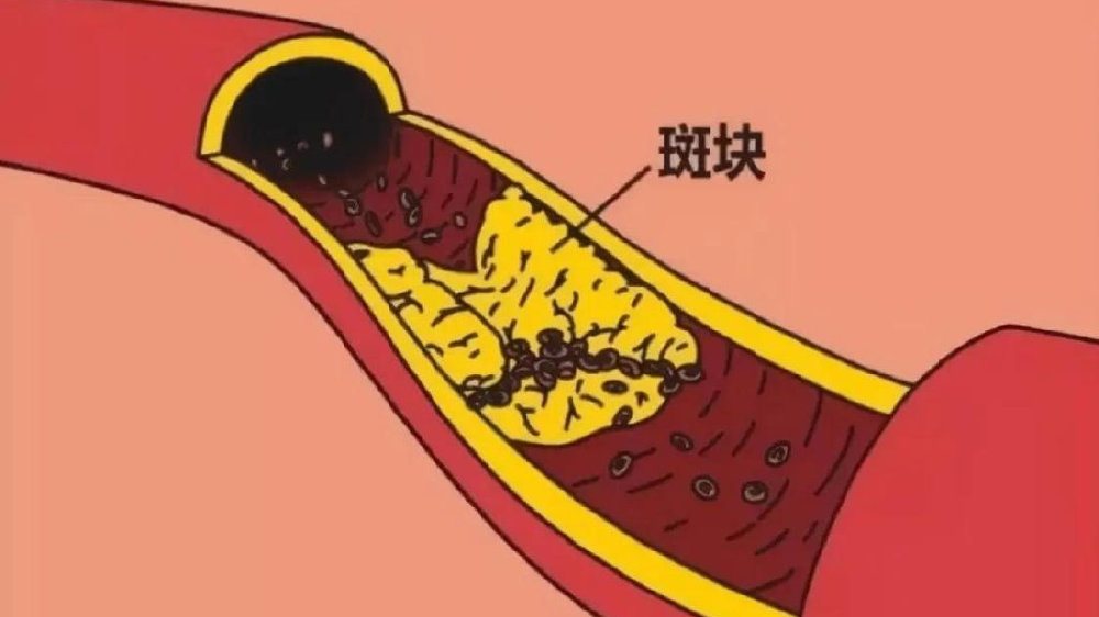 动脉斑块真的可以逆转 动脉斑块能否彻底消除