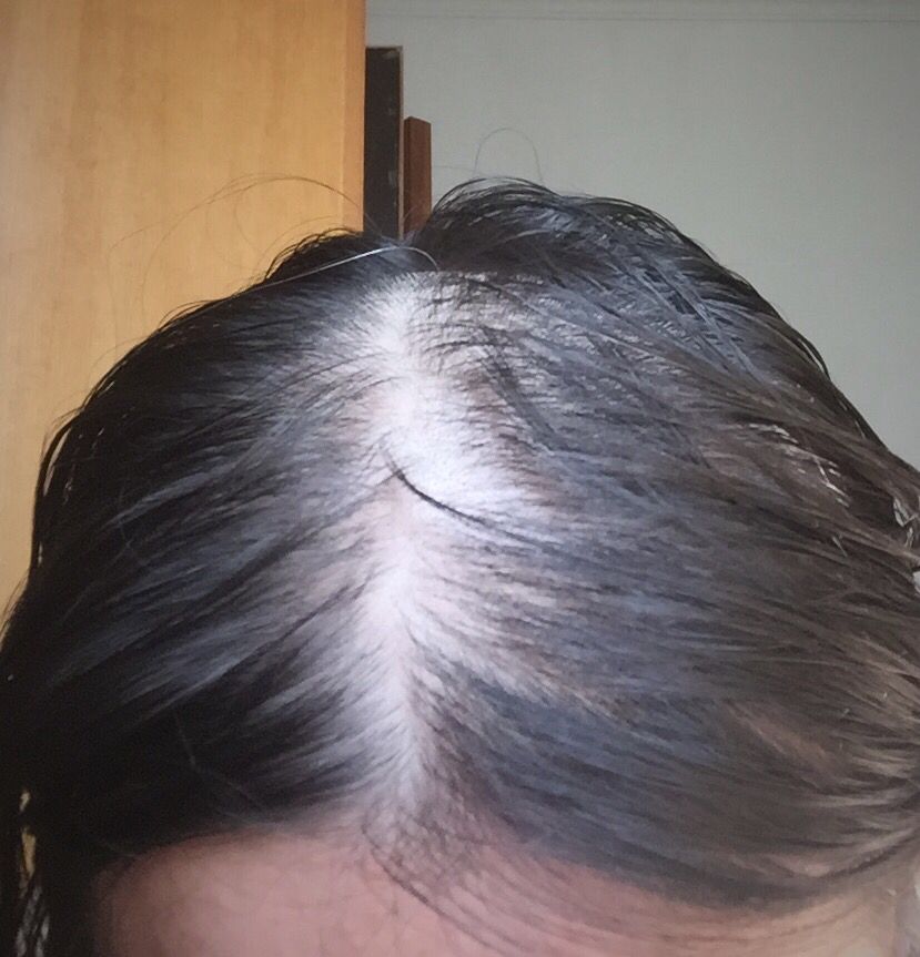 掉发,发质干枯,头发长得慢?专家:很可能是身体缺乏这些元素