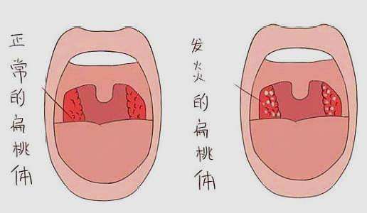 扁桃体发炎,应该怎么办?看看医生怎么说