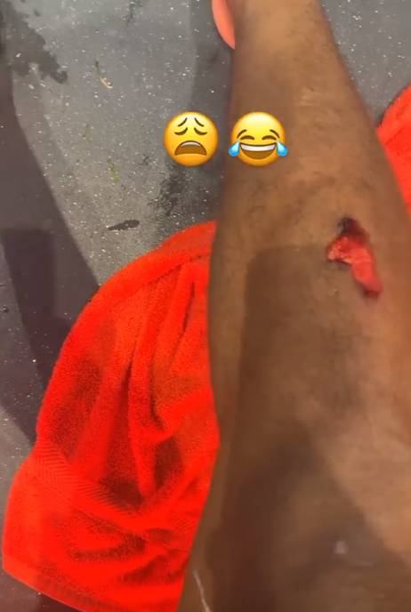 马夏尔晒左右脚伤口