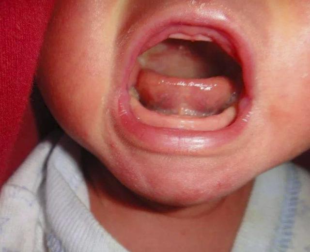 给新生宝宝割"舌系带",结果孩子再没开口说过话|舌系带|舌根|舌头