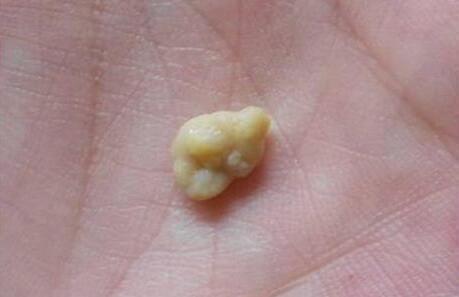 总是感到喉咙里有东西吃饭时却咳出小石头原来是它在作怪