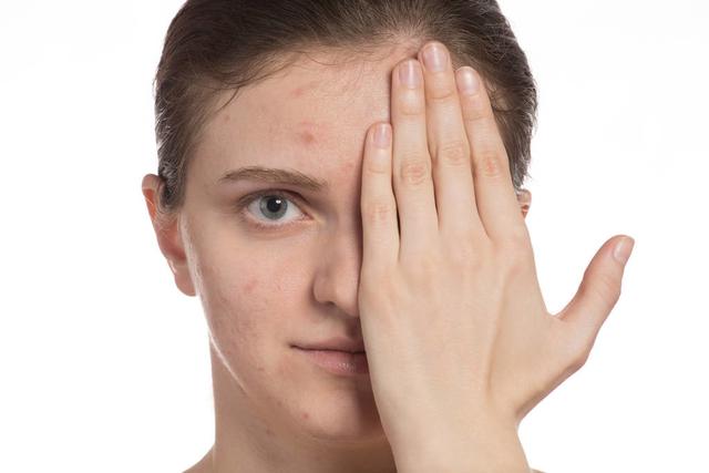 困扰多年的皮肤问题,竟因戒掉奶茶而"消失"了,不妨看看原因