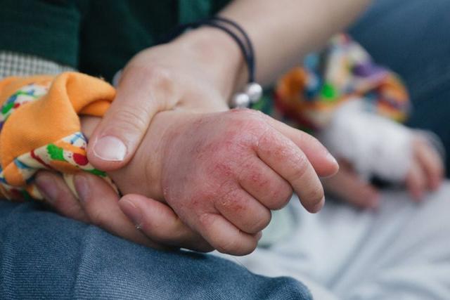 1岁宝宝起湿疹使用偏方后病情反加重小心这些民间育儿法