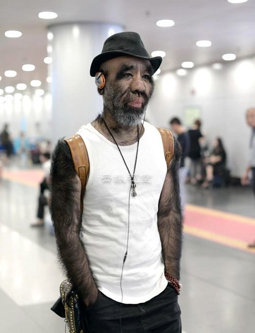 出生便患有多毛症体毛太多遭人排斥如今的模样却美翻全场