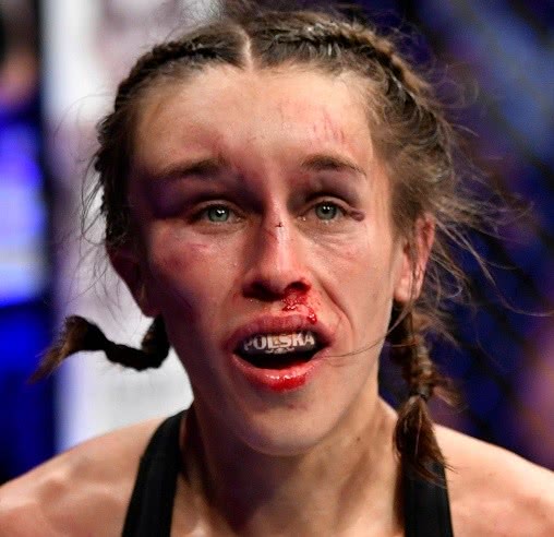 乔安娜晒最新照片墨镜鸭舌帽挡住脸下周去整容