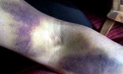 女子醒后发现全身都是淤青去医院检查医生的一句话陷入绝望