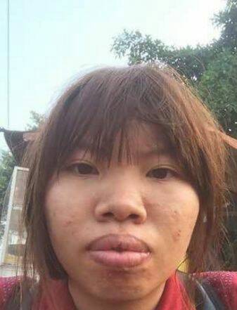 女孩因长相丑陋,找不到男友,怒去整容,如今嫁给富二代