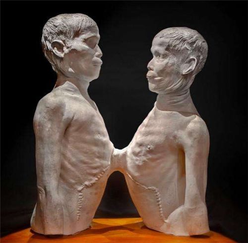 华裔连体兄弟,因身体特殊被展览,走红后还迎娶了一对双胞胎姐妹