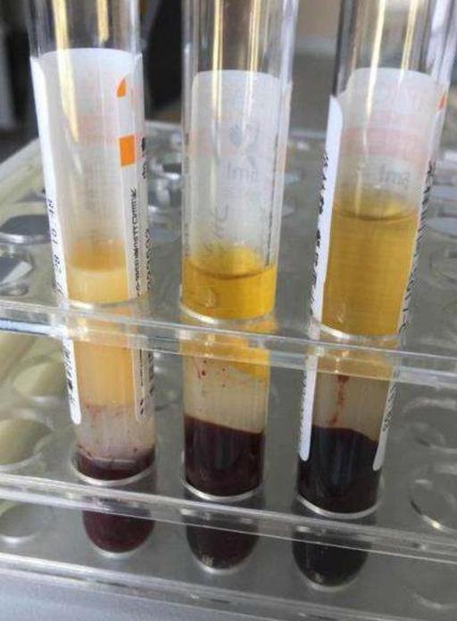 高血脂为何会引起急性胰腺炎如何控制风险医生告诉你真相