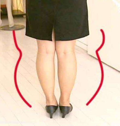 下面这张更明显一点,虽然跟腱隐藏在脂肪里,还是能看出来跟腱很短.