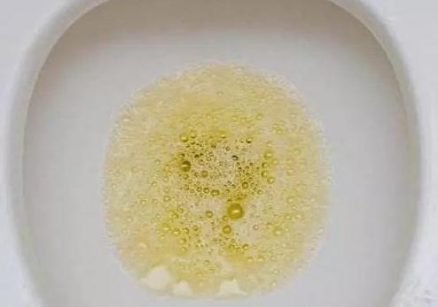 若发现尿液颜色呈深黄色,犹如茶色,或呈红色,小心尿潜血,这时,可能是