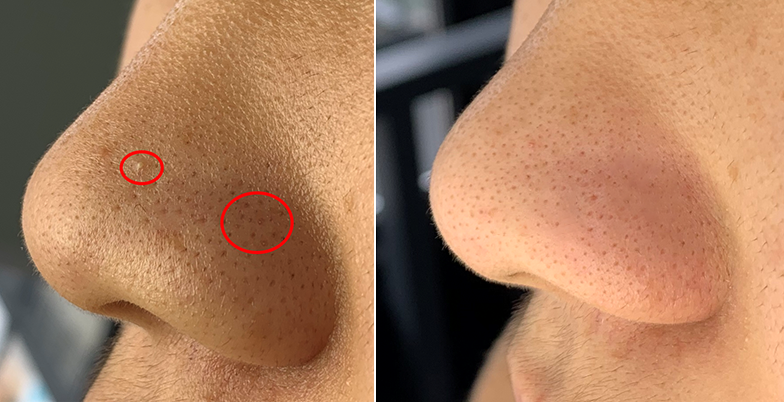 3分钟拯救"陈年草莓鼻"?黑头连根吸出!一键清零毛孔,细腻,滑嫩到爆表!