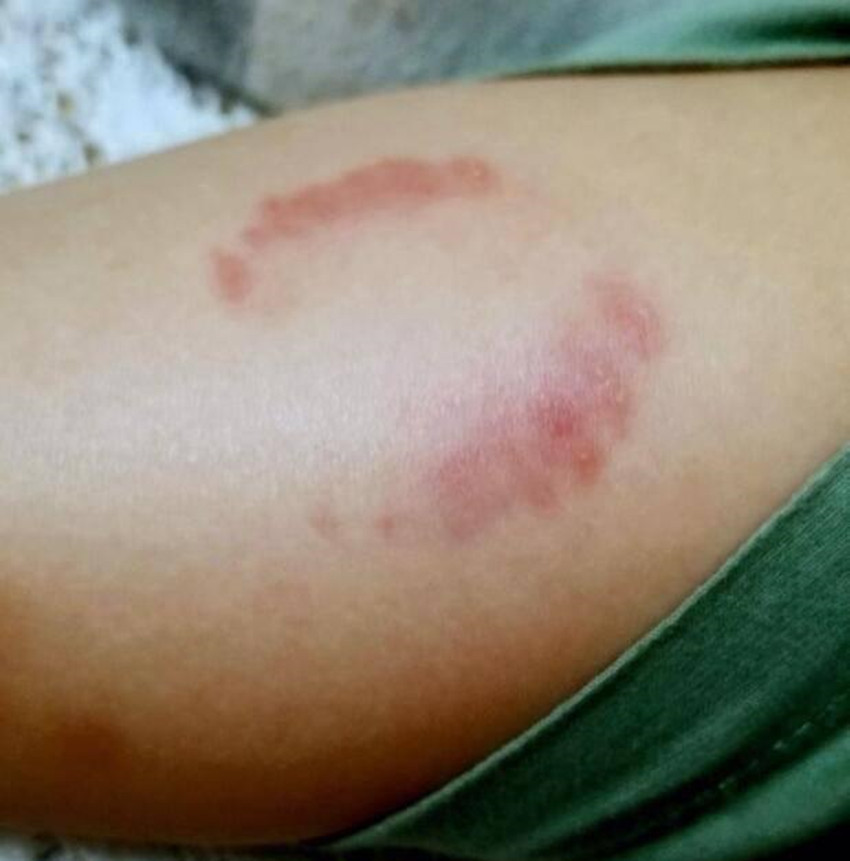 4岁儿子在幼儿园被同学咬伤,妈妈得知后,神一般的操作令人窒息