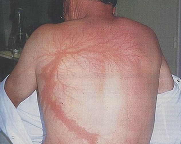 被雷击中会有"超能力"?这些人都曾亲身经历