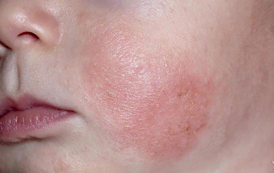 宝宝月子里容易出现湿疹,做好一些预防性护理工作,让宝宝少遭罪