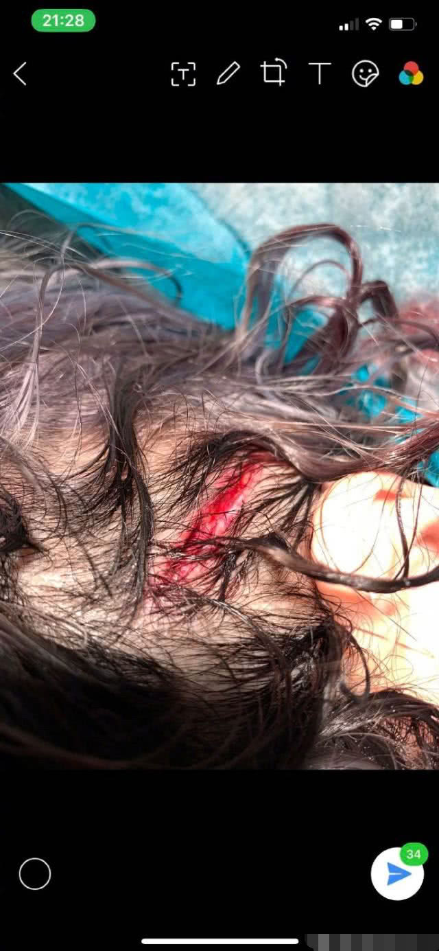 萧亚轩晒照自曝去年头部严重创伤,伤口打上6枚钢针惹网友心疼!