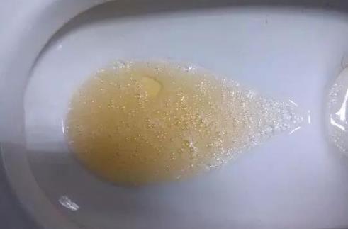 尿液中有大量的泡沫出现,是不是肾脏生病了?答案或许没那么简单
