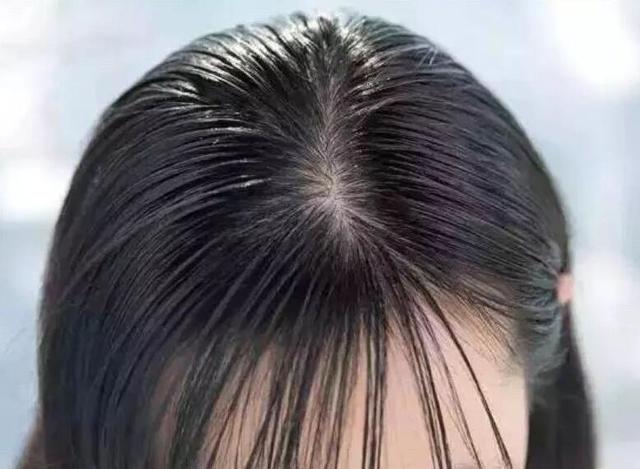 头发出油多油腻异味惹人烦摆脱头皮尴尬只需2个简单技巧