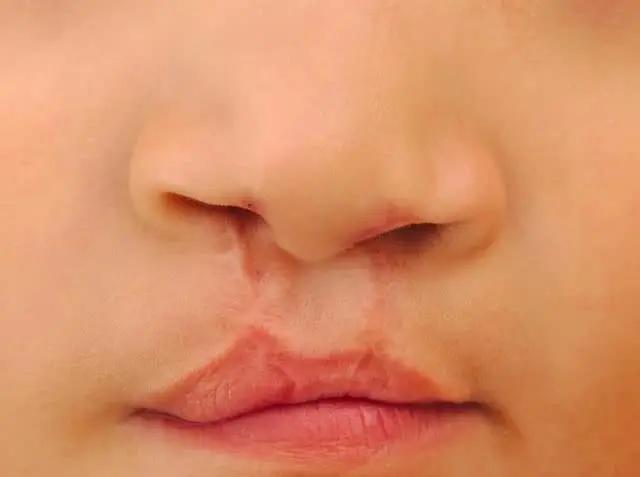 数据显示,中国大约每800名新生儿中,就有一名唇腭裂患儿,每8000人中