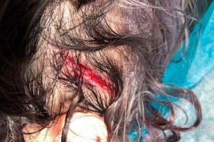 萧亚轩公开意外受伤照片,头部缝6针,为什么每次发专辑就出事?