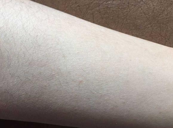小腿干燥脱皮和鱼鳞一样,是皮肤缺水还是皮肤病?答案那么简单!