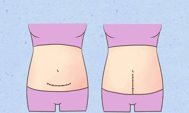 同样是"挨一刀",侧切与剖腹产哪个少遭罪?|剖腹产|切口|顺产_新浪新闻