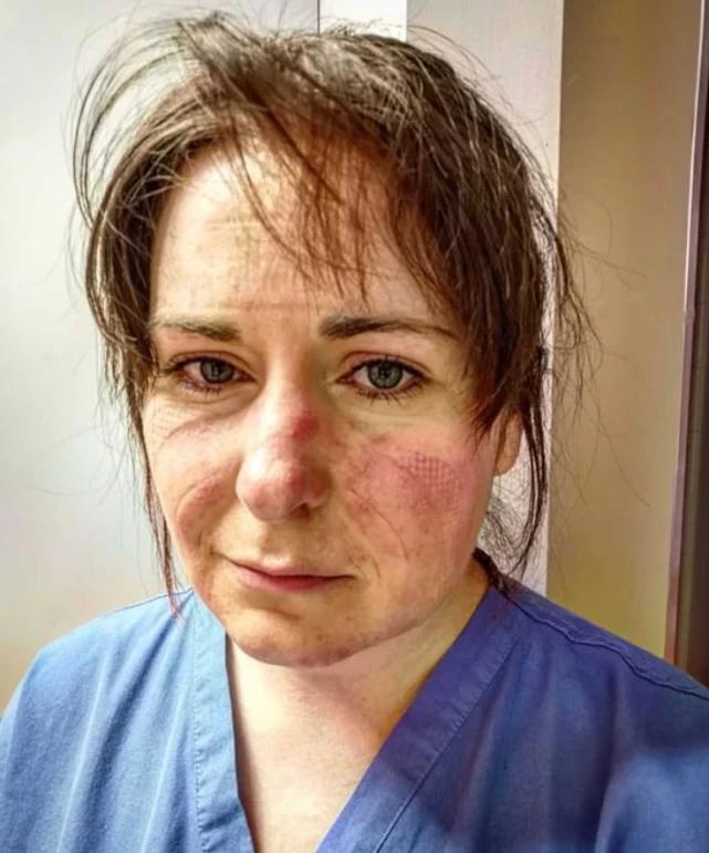 英国护士晒出她口罩下的脸恳求人们不要外出,满是瘀伤令人心碎