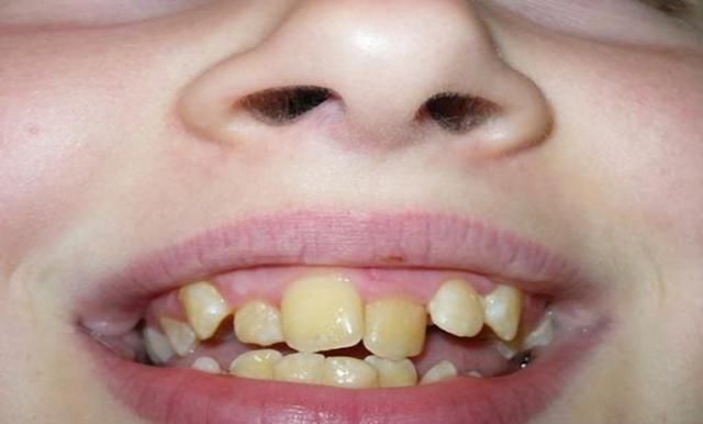 换牙期孩子牙齿越长越歪,多半"另有原因"