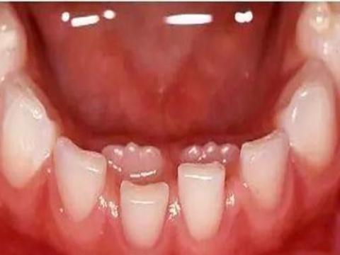 换牙期孩子牙齿越长越歪 多半 另有原因