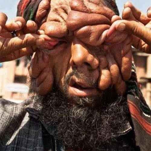 男子身染怪病无比丑陋妻子不离不弃相伴左右终获爱情结晶