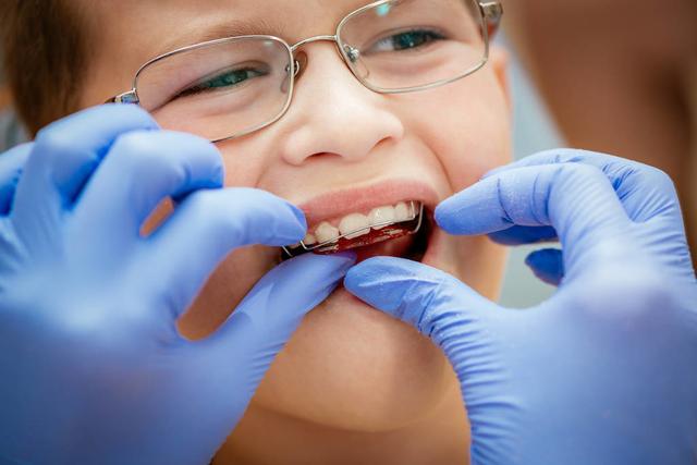 儿童箍牙齿图片过程图片