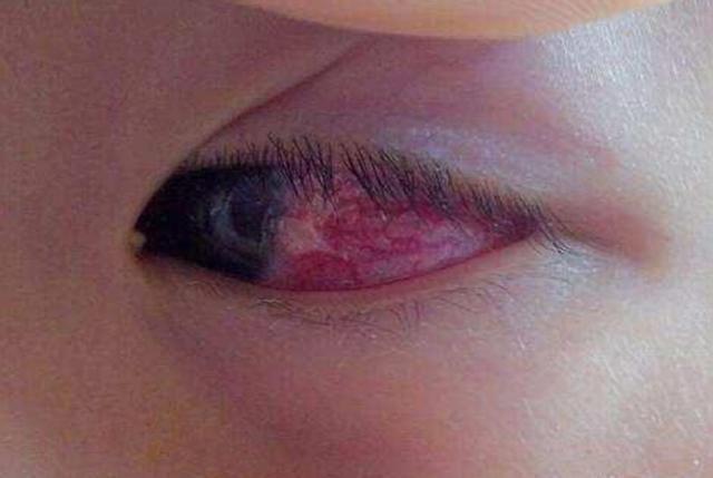 4个月的宝宝双眼近乎失明罪魁祸首就是爹妈看看你有没