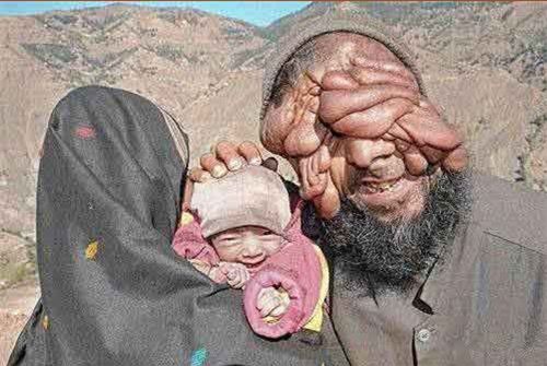 男子身染怪病无比丑陋妻子不离不弃相伴左右终获爱情结晶