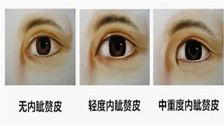 正文       第三印记:内眦褶.内眦褶是眼角内部上眼睑内向皱襞的结果.