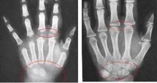 孩子"骨骺线闭合"前,会有3个信号,抓住机会,孩子还能再长高