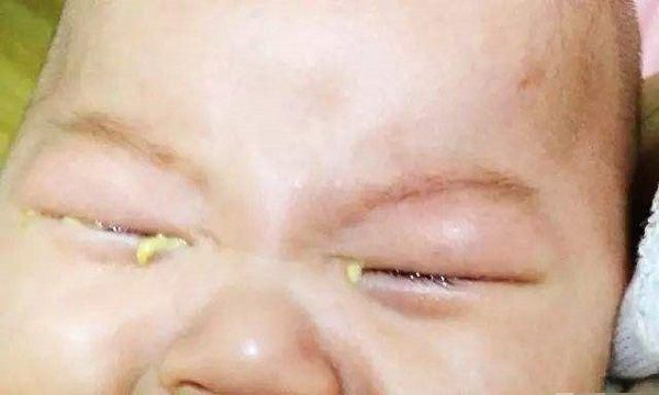 新生儿出生后,要预防这类眼部疾病,爸妈做到这些