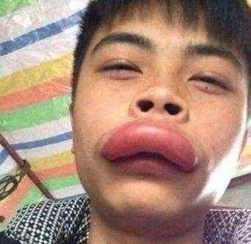 一对熊孩子捅马蜂窝,结果被蛰成"猪头"