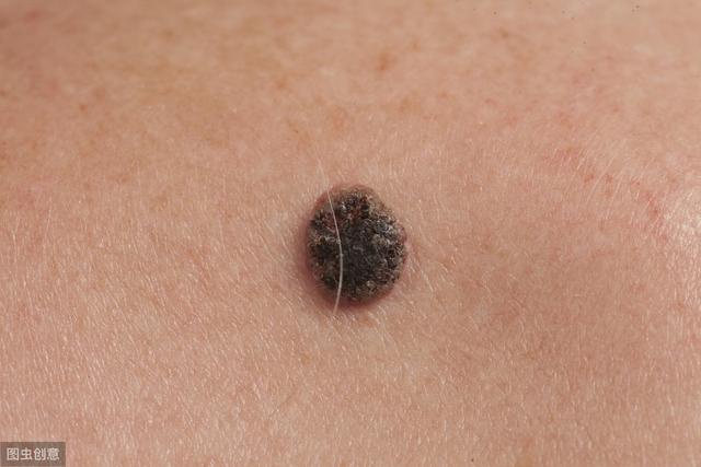 身上长的小黑痣,一不小心可能会癌变,这4种痣最容易变成瘤!