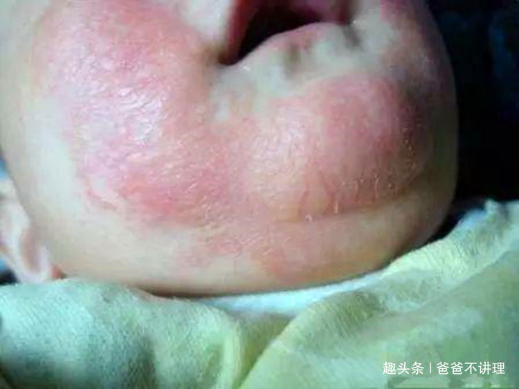 母乳性湿疹的特征图片