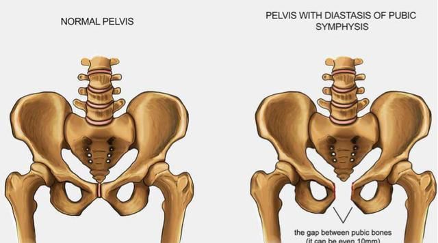 产后胯变宽了,做骨盆修复就好?妈妈们又被骗了!