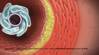 不止一种|支架|血管|患者_新浪新闻