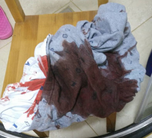 常州一男童半夜血染床单,竟是体内这东西掉了下来