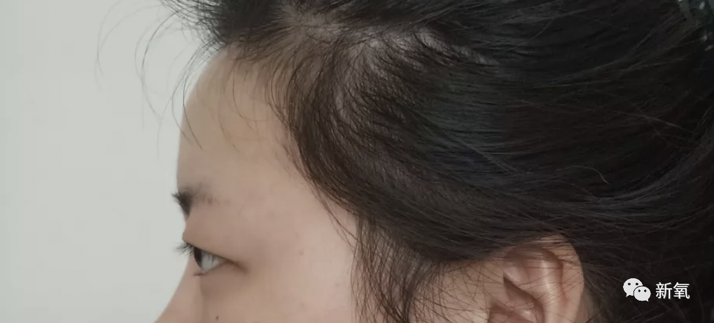 山根和眉弓过平,或是上眼皮脂肪过厚(视觉上就会有一定的眼球外凸感)