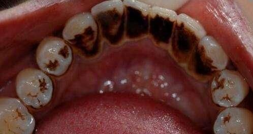 里面的酸性物质反应,就很容易产生牙渍,并且不易清理,刷牙很难刷掉,日