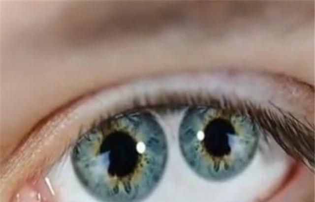 这种人确实是存在,之所以会形成这种现状,是因为他们患有虹膜异色症