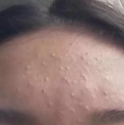 鸡皮肤怎么去闭口精华(鸡皮肤怎么去闭口精华霜) 鸡皮肤怎么去闭口精华(鸡皮肤怎么去闭口精华霜)